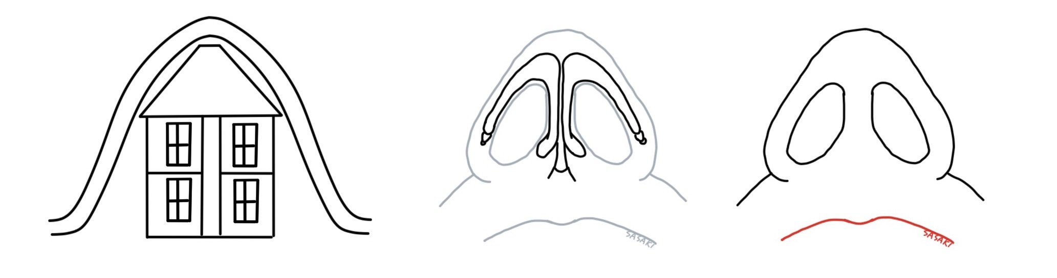 鼻中隔延長を模式図で表現したもの