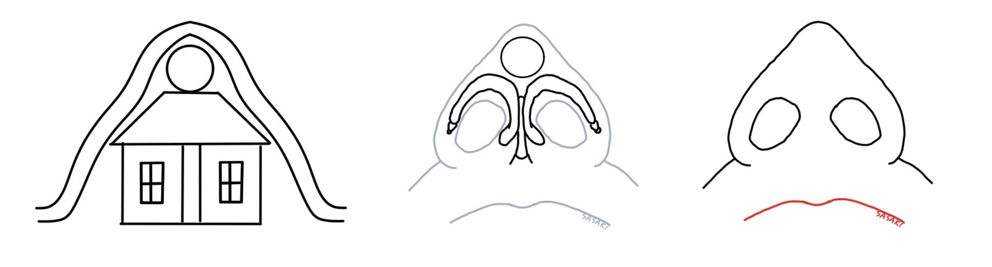 オステオポールで鼻先を高くした状態を模式図で表現したもの