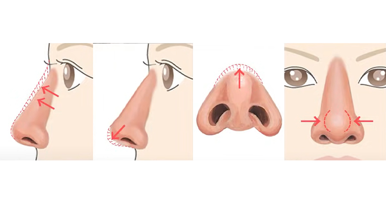 鼻の形成の種類